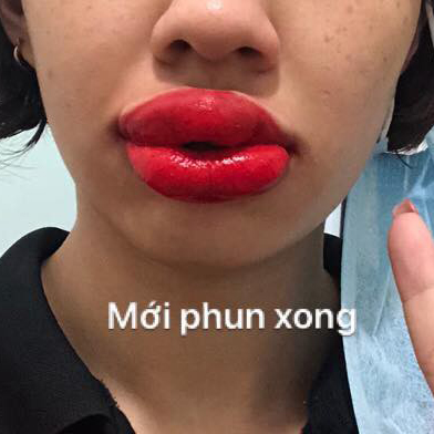 môi bị sưng sau khi phun môi