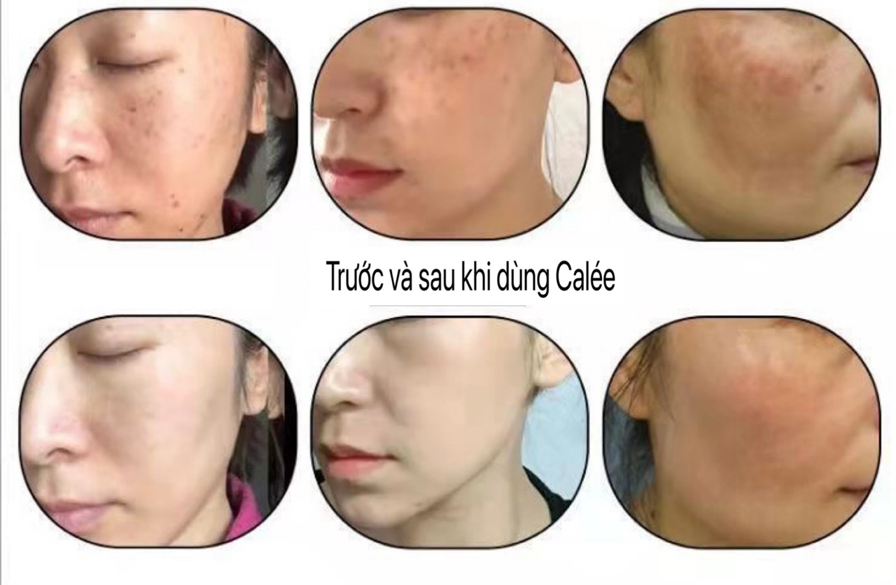 Nám da là gì ? z3524176338751 0bc1e4ddf9ed86e1089696bd6099d6f7